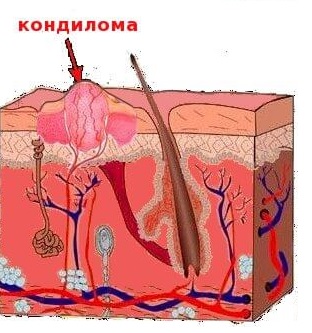 Как избавиться от кондиломы?1