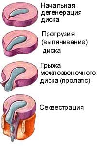 Протрузия позвоночника: причины, лечение, профилактика1
