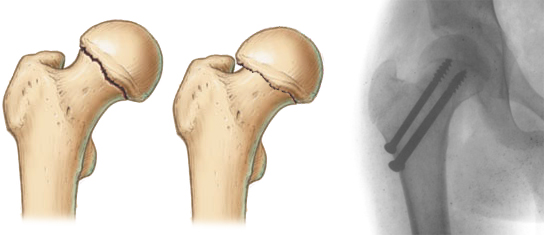 Перелом шейки бедра: особенности травмы1