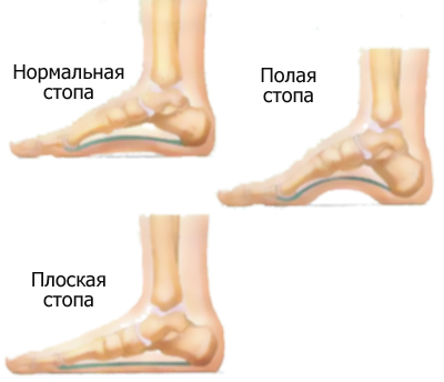Плоскостопие: симптомы, причины, стадии1
