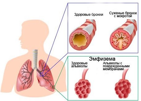 Обструкция верхних дыхательных путей1