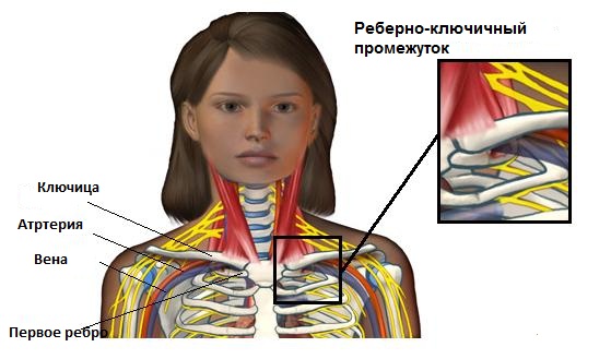 Синдром лестничной мышцы: симптомы, диагностика, лечение1