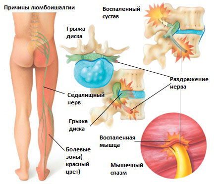 Люмбоишиалгия: острая, хроническая, симптомы, лечение1
