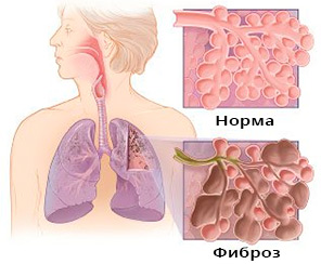 Фиброз легких: симптомы, лечение, прогноз1