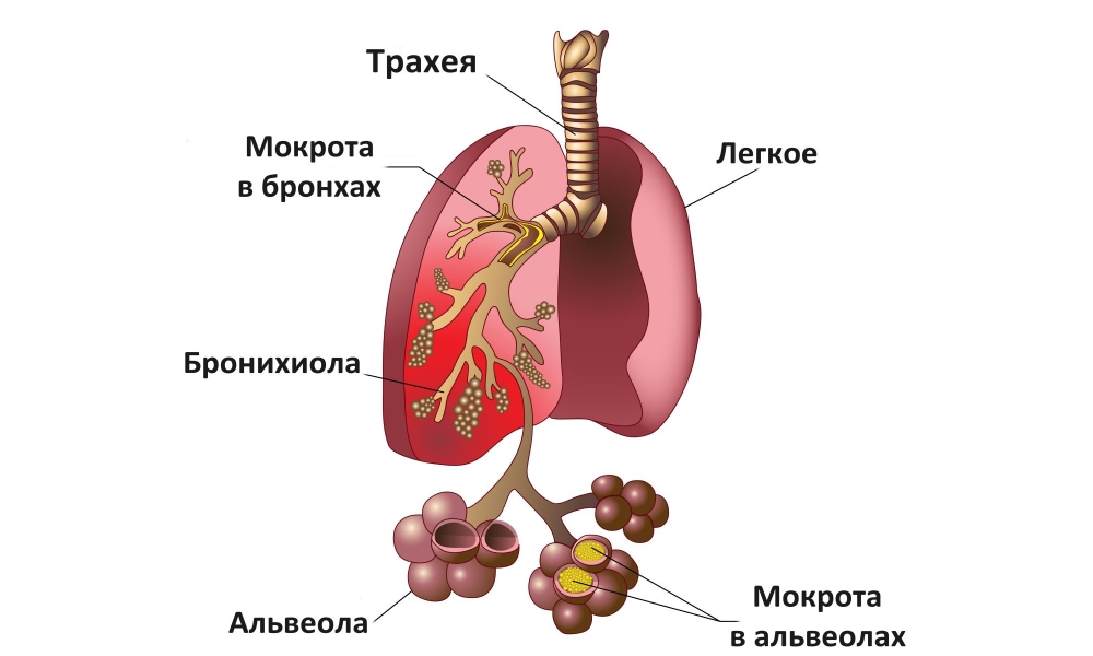 Шоковое легкое: патогенез, лечение1