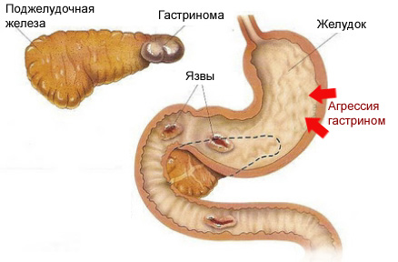 Синдром Золлингера-Эллисона: симптомы, диагностика, лечение1