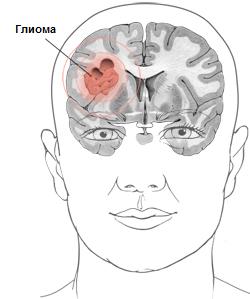 Глиома головного мозга 1