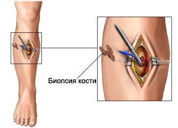 Саркома Юинга: симптомы, стадии, диагностика, лечение, прогноз1