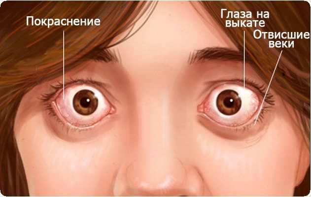 Эндокринная офтальмопатия: симптомы, причины, лечение1