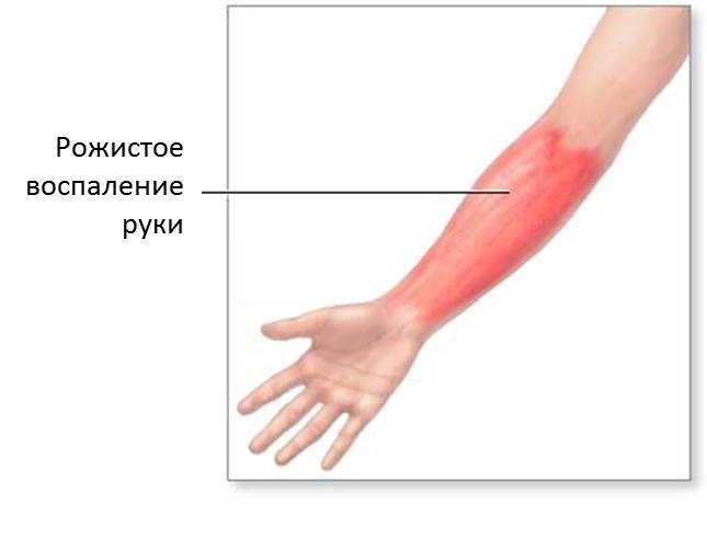 Рожистое воспаление: симптомы, формы, лечение1
