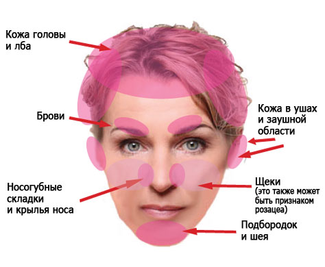 Себорейный дерматит на лице: симптомы, лечение1