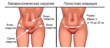 Преимущества лапароскопии. Анестезия при лапароскопии1