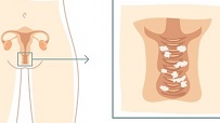 Белые выделения у девушек: причины, как лечить
