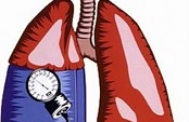 Диагностика и лечение легочной гипертензии