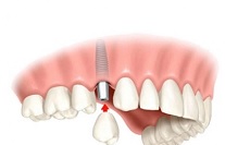 Замещение одиночных зубов