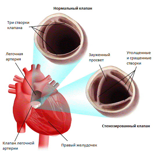 Пороки легочной артерии2