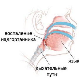 Паралич голосовых связок2