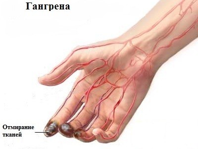 Гангрена2