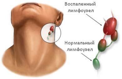 Лимфаденит2