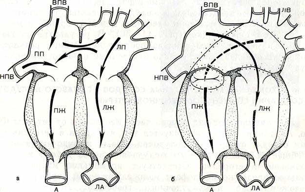 Транспозиция магистральных сосудов: операция, этапы, последствия2