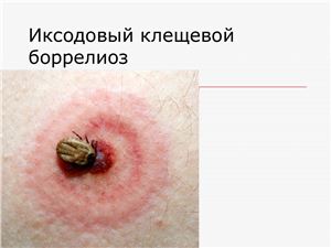 Клещевой боррелиоз или Болезнь Лайма2
