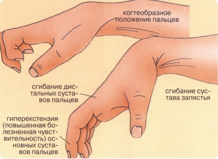 Деформация кистей2