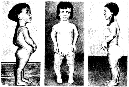 Ахондроплазия: симптомы, причины, лечение2