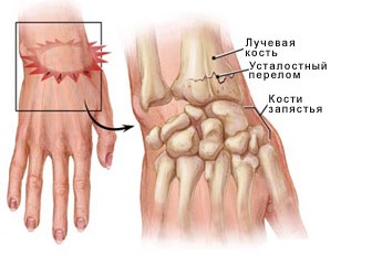 Травмы лучезапястного сустава2