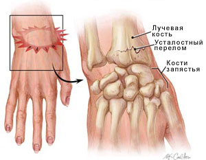 Вывихи в лучезапястном суставе2