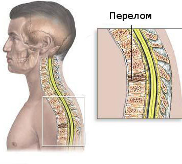 Лечение переломов у детей2