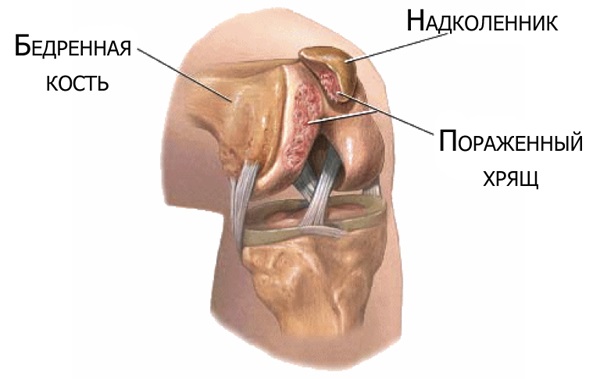 Хондромаляция надколенника2