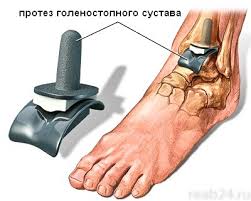 Заболевания голеностопного сустава2
