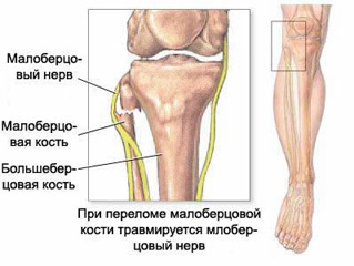 Перелом малоберцовой и большеберцовой кости2