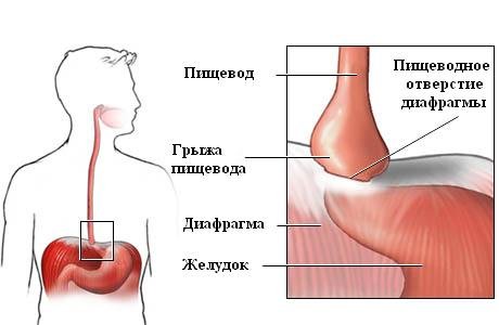 Грыжа пищеводного отверстия диафрагмы2