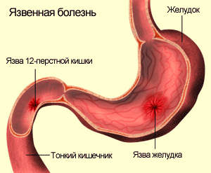 Перфоративная язва двенадцатиперстной кишки2