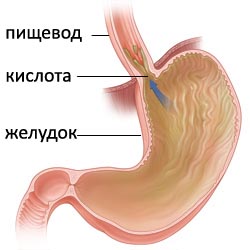 Лечение гастроэзофагеальной рефлюксной болезни2