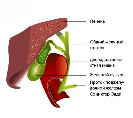 Лечение дисфункции сфинктера Одди2
