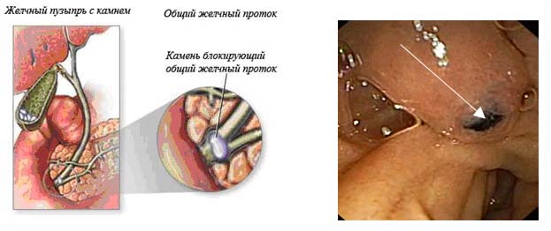 Эндоскопическая папиллосфинктеротомия2