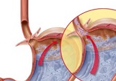 Лечение гастроэзофагеальной рефлюксной болезни