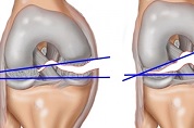 Повреждения связок коленного сустава