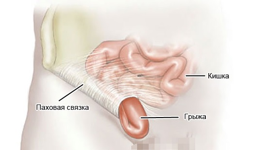 Эндоскопипческая операция по удалению грыжи2