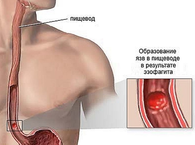 Торакоскопическая ваготомия2