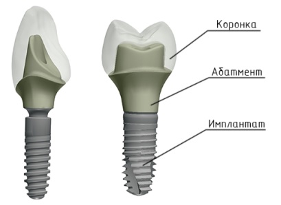 Естественный абатмент2