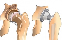 Осложнения после эндопротезирования тазобедренного сустава