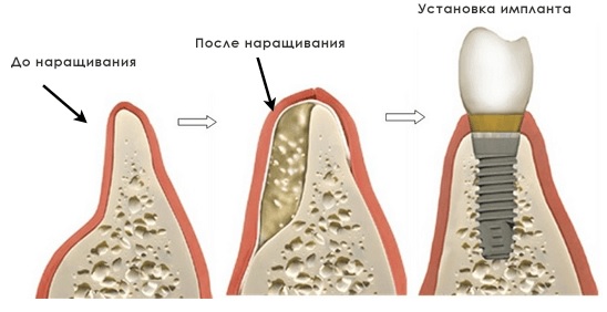 Реакция кости на имплантат2