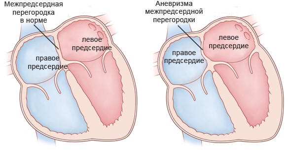 Вторичный дефект межпредсердной перегородки2