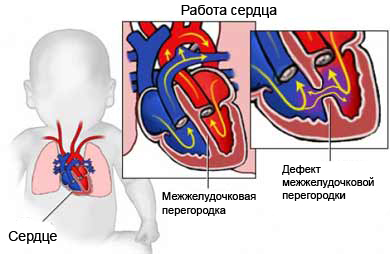 Атриовентрикулярный септальный дефект2