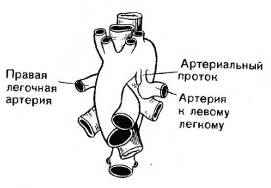 Аномалии дуги аорты2