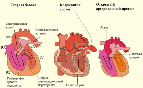 Врожденные пороки сердца2