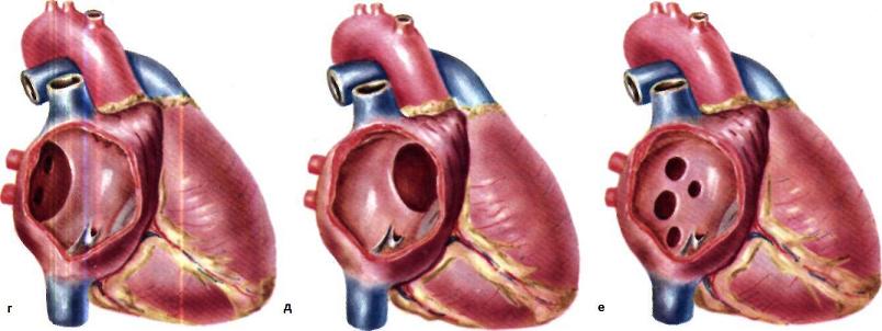 Врожденный дефект межжелудочковой перегородки2